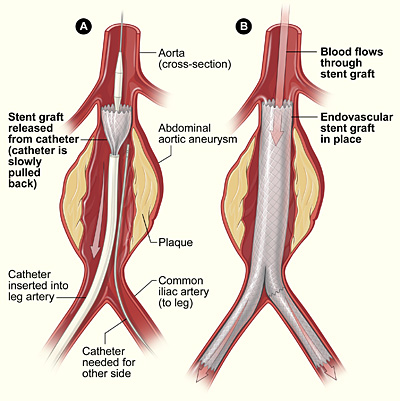 endovascular stent