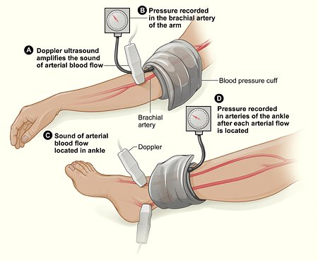 ankle-brachial index (ABI) test