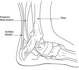 Achilles tendinitis