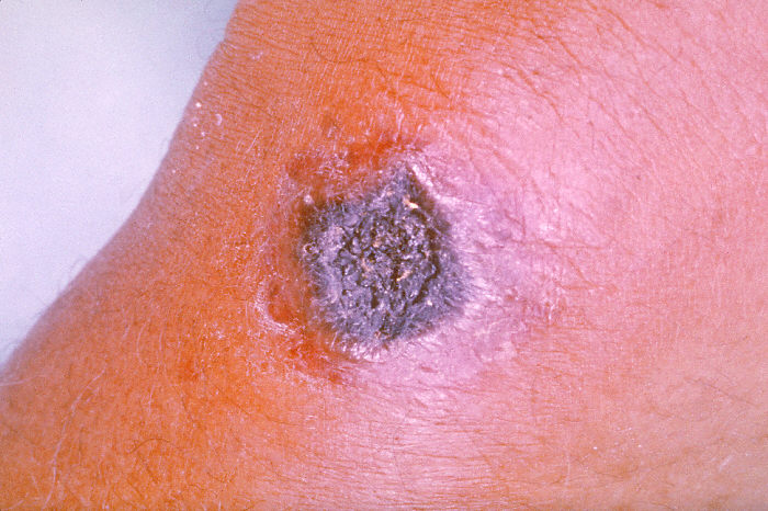 anthrax lesion