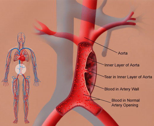 aortic dissection