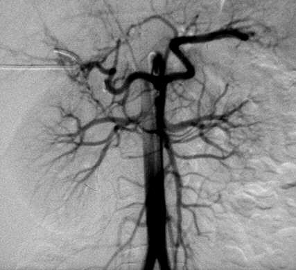 abdominal aortography