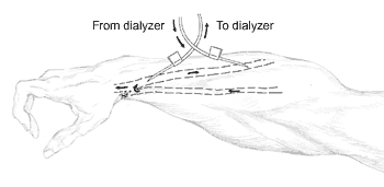 arterial and venous needles