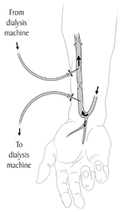 arteriovenous fistula
