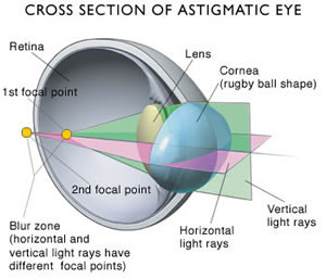 astigmatic eye
