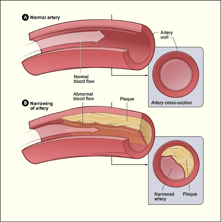 normal and narrowed arteries