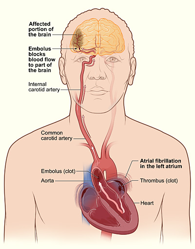 atrial fibrillation and stroke