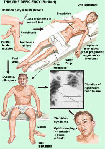 symptoms of beriberi