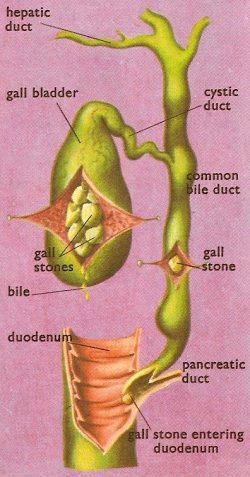 biliary system and gallstones