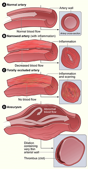 blocked arteries