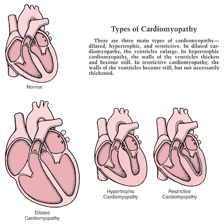 types of cardiomyopathy