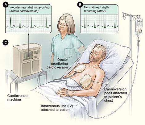 cardioversion