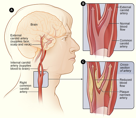 carotid anatomy