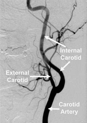 carotid angiogra
