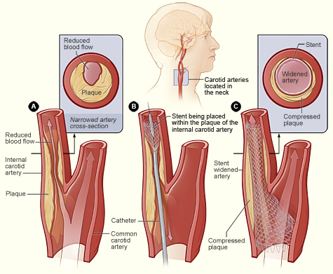 carotid artery stenting