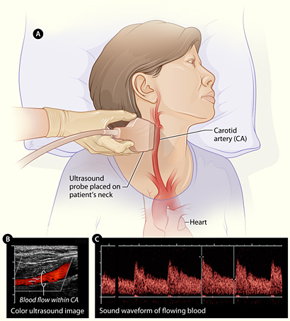 carotid ultrasound