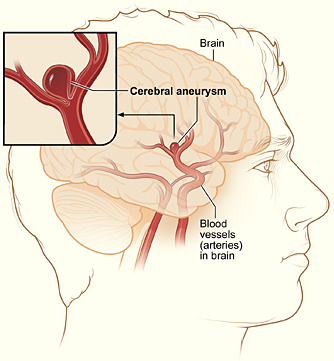 cerebral aneurysmm