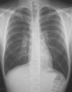 chest X-ray