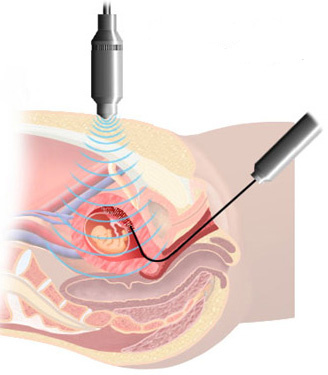 chorionic villus sampling