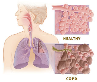 chronic obstructive pulmonary disease