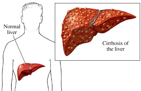 cirrhosis of the liver