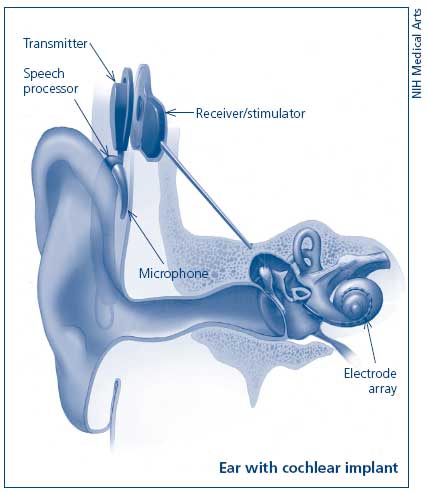 cochlear implant