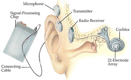 cochlear implant