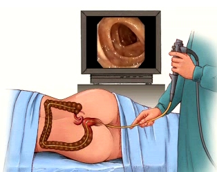 colonoscopy