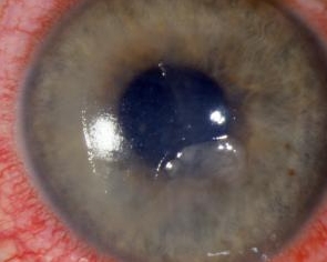 corneal abrasion