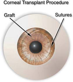 corneal transplant