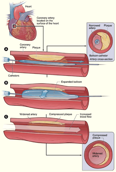 coronary artery with plaque buildup