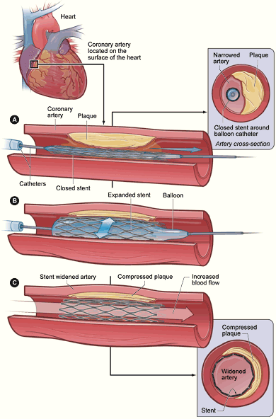 placement of stent in coronary artery