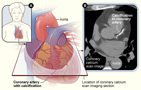 coronary calcium scan