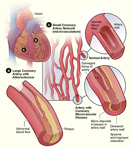 coronary microvascular disease