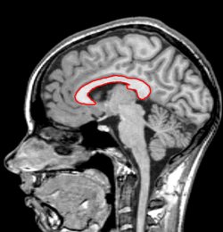 corpus callosum