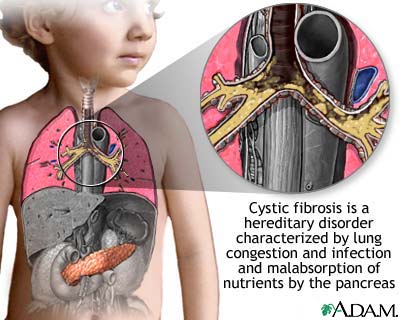 cystic fibrosis