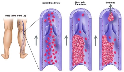 deep vein thrombosis