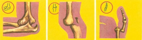 dislocations