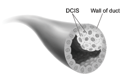 ductal carcinoma in situ