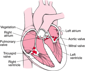 endocarditis