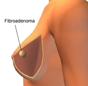 fibroadenoma