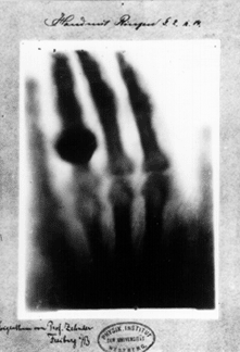 X-ray of Rontgen's wife's hand
