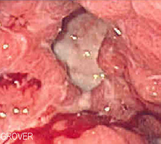 endoscopic image of a gastric ulcer