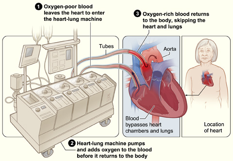 heart-lung machine