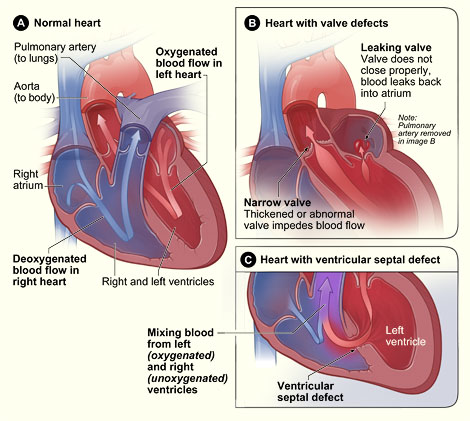 heart murmur