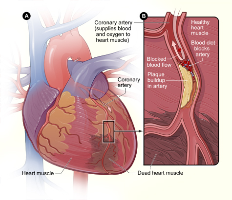 Figure A is an overview of a heart and coronary artery showing damage (dead heart muscle) caused by a heart attack. Figure B is a cross-section of the coronary artery with plaque buildup and a blood clot resulting from plaque rupture.