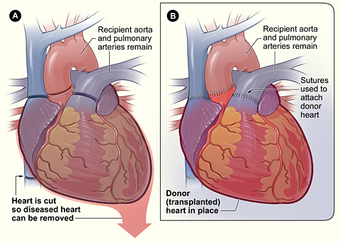 heart transplant