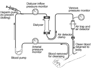 hemodialysis