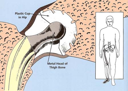 hip replacement