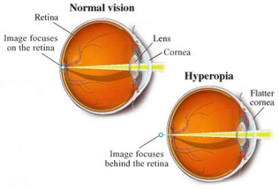 hyperopia explained